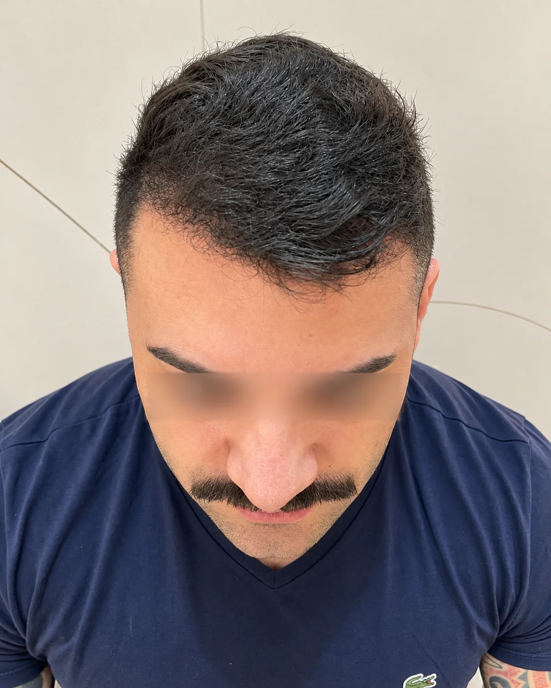 006-capilar-masculino-depois